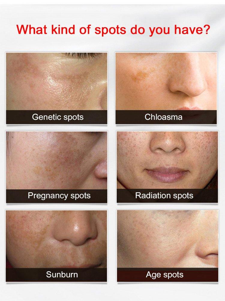 Niacinamide Whitening and freckle removal Cream